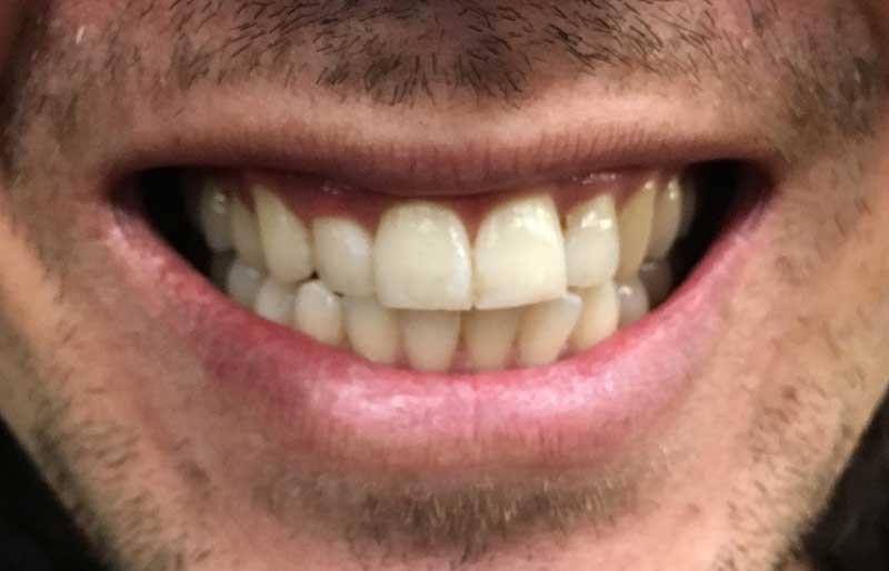 james-after-teeth