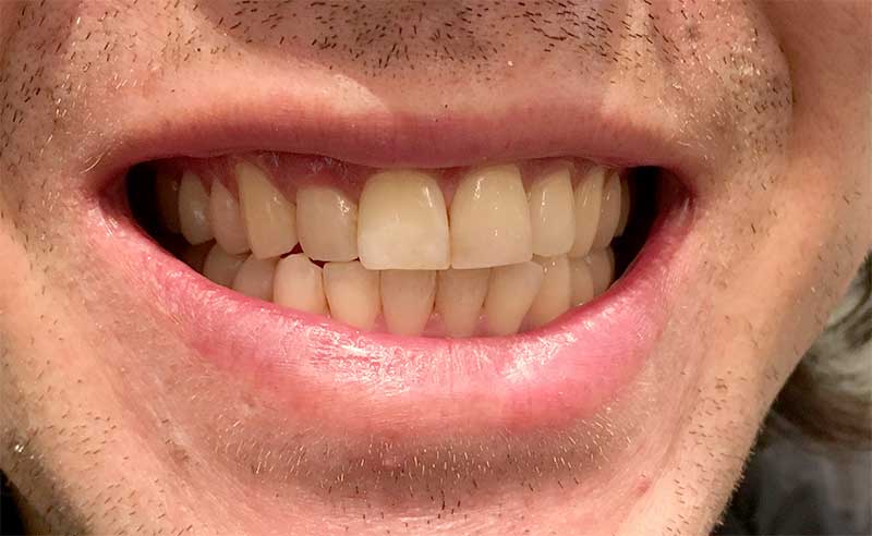 james-before-teeth