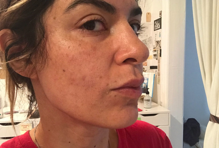 What Microneedling with Radiofrequency looks like! Pretty Connected